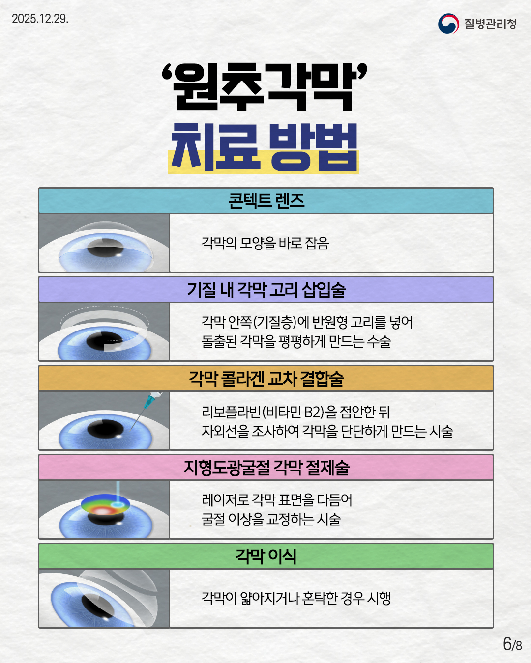 6P '원추각막' 치료 방법  콘텍트 렌즈 각막의 모양을 바로 잡음  기질 내 각막 고리 삽입술 각막 안쪽 (기질층)에 반원형 고리를 넣어 돌출된 각막을 평평하게 만드는 수술  각막 콜라겐 교차 결합술 리보플라빈 (비타민 B2)를 점안한 뒤 자외선을 조사하여 각막을 단단하게 만드는 시술  지형도광굴절 각막 절제술 레이저로 각막 표면을 다듬어 굴절 이상을 교정하는 시술  각막 이식 각막이 얇아지거나 혼탁한 경우 시행