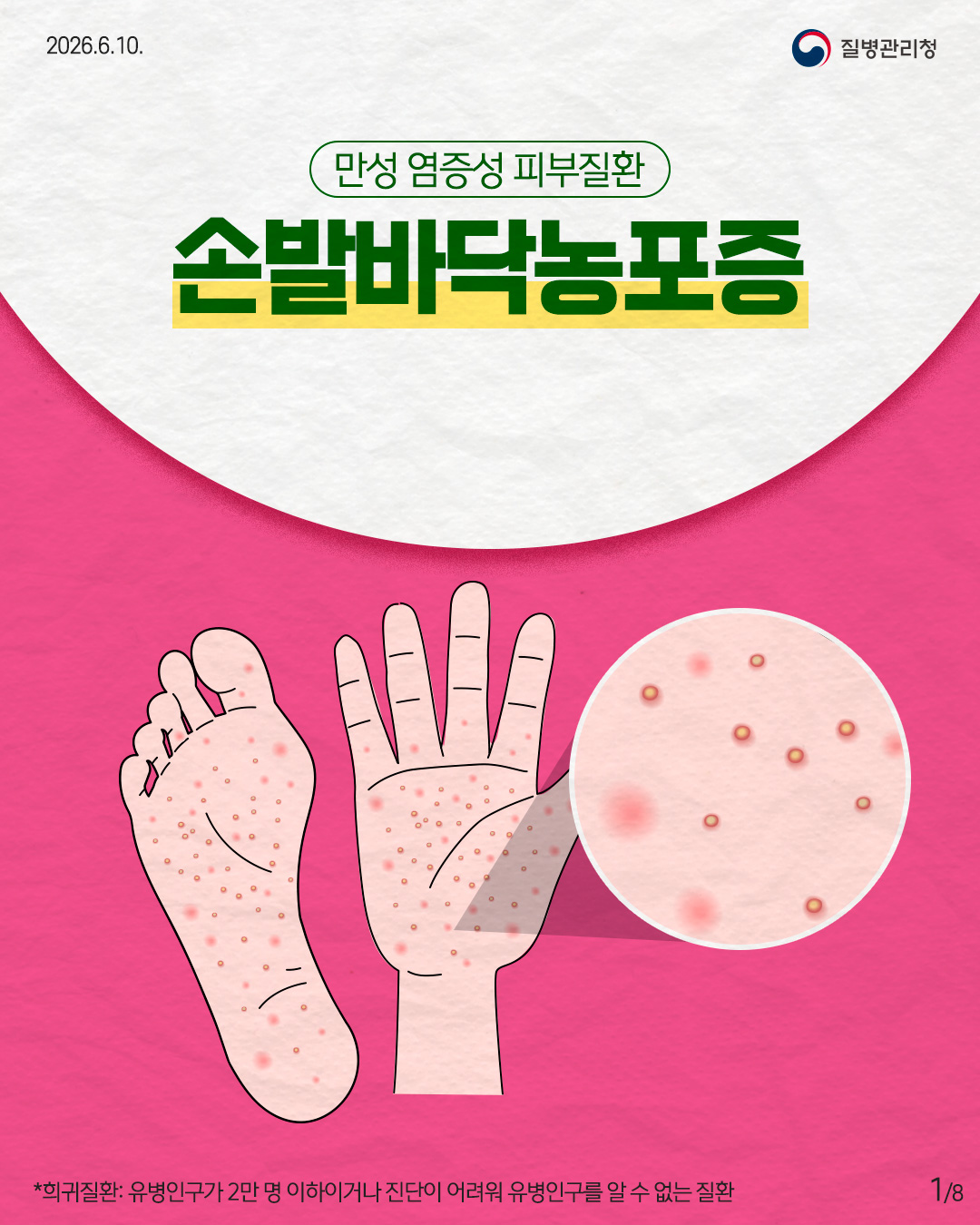 1페이지 만성 염증성 피부질환 손발바닥농포증 *희귀질환: 유병인구가 2만 명 이하이거나 진단이 어려워 유병인구를 알 수 없는 질환