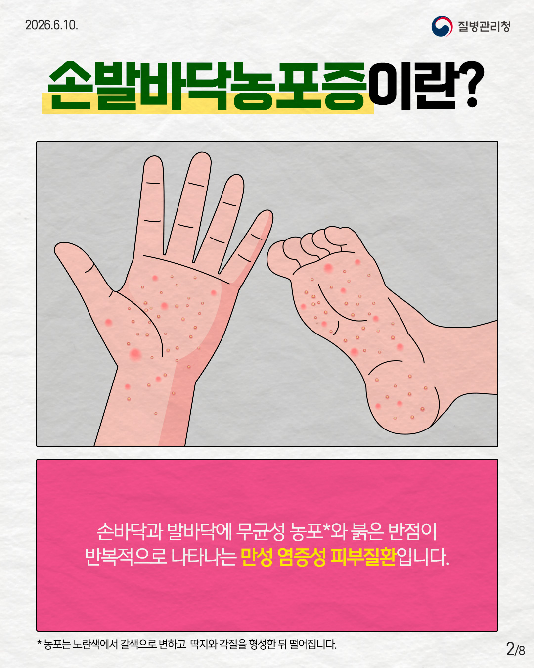 2페이지 손발바닥농포증이란? 손바닥과 발바닥에 무균성 농포*와 붉은 반점이 반복적으로 나타나는 만성 염증성 피부질환입니다. * 농포는 노란색에서 갈색으로 변하고 딱지와 각질을 형성한 뒤 떨어집니다.