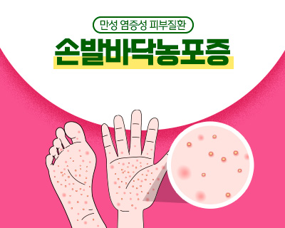 만성 염증성 피부질환 손발바닥농포증  *희귀질환: 유병인구가 2만 명 이하이거나 진단이 어려워 유병인구를 알 수 없는 질환