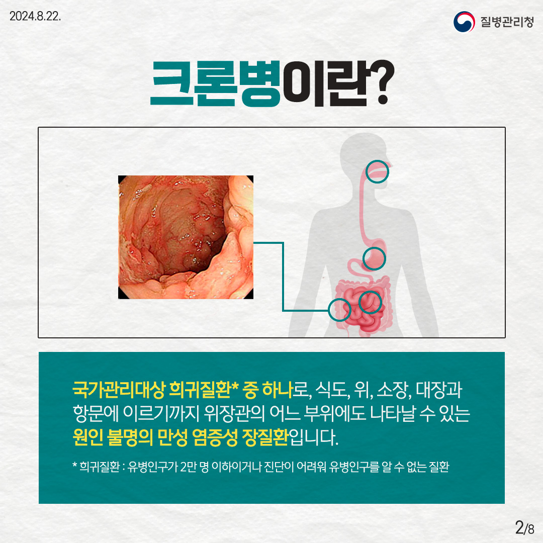 크론병이란? 국가관리대상 희귀질환* 중 하나로, 식도, 위, 소장, 대장과 항문에 이르기까지 위장관의 어느 부위에도 나타날 수 있는 원인 불명의 만성 염증성 장질환입니다. * 희귀질환 : 유병인구가 2만 명 이하이거나 진단이 어려워 유병인구를 알 수 없는 질환