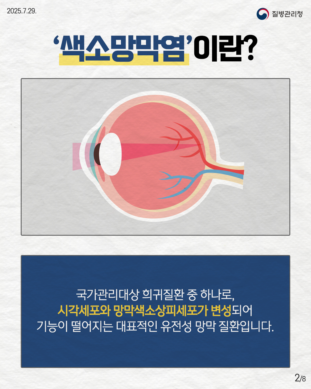 2025.7.29. 질병관리청 1P 유전성 망막질환 색소망막염 *희귀질환: 유병인구가 2만 명 이하이거나 진단이 어려워 유병인구를 알 수 없는 질환