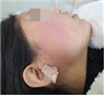한센병으로 인해 얼굴이 붉어진 모습 사진