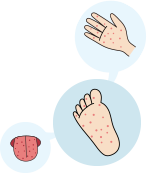 수족구병 관련 일러스트