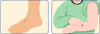 발등, 팔목에 진드기 물린자국 일러스트