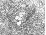 Russian spring­summer encephalitis (RSSE) virions 병원체 이미지입니다. 