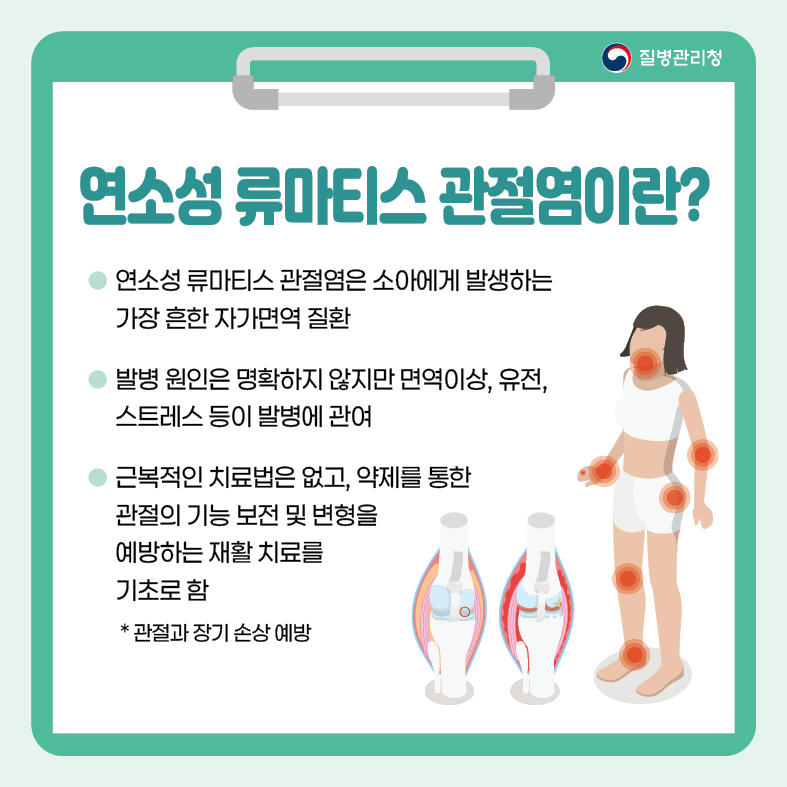 <연소성 류마티스 관절염>
1. 연소성 류마티스 관절염이란?
- 연소성 류마티스 관절염은 소아에게 발생하는 가장 흔한 자가면역 질환
- 발병 원인은 명확하지 않지만 면역이상, 유전, 스트레스 등이 발병에 관여
- 근복적인 치료법은 없고, 약제를 통한 관절의 기능 보전 및 변형을 예방하는 재활 치료를 기초로 함
* 관절과 장기 손상 예방