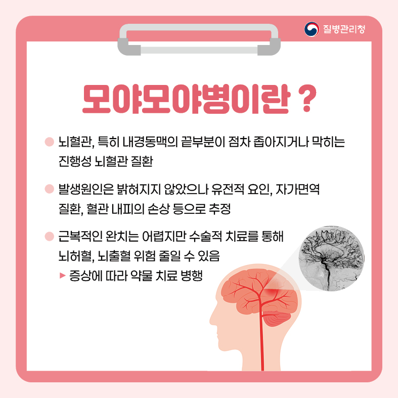 <모야모야병>
1. 모야모야병이란 ?
- 뇌혈관, 특히 내경동맥의 끝부분이 점차 좁아지거나 막히는 진행성 뇌혈관 질환
- 발생원인은 밝혀지지 않았으나 유전적 요인, 자가면역 질환, 혈관 내피의 손상 등으로 추정
- 근복적인 완치는 어렵지만 수술적 치료를 통해 뇌허혈, 뇌출혈 위험 줄일 수 있음
 ·증상에 따라 약물 치료 병행